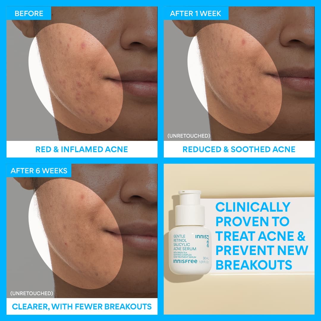 Gentle Retinol Salicylic Acne Serum - Image 4