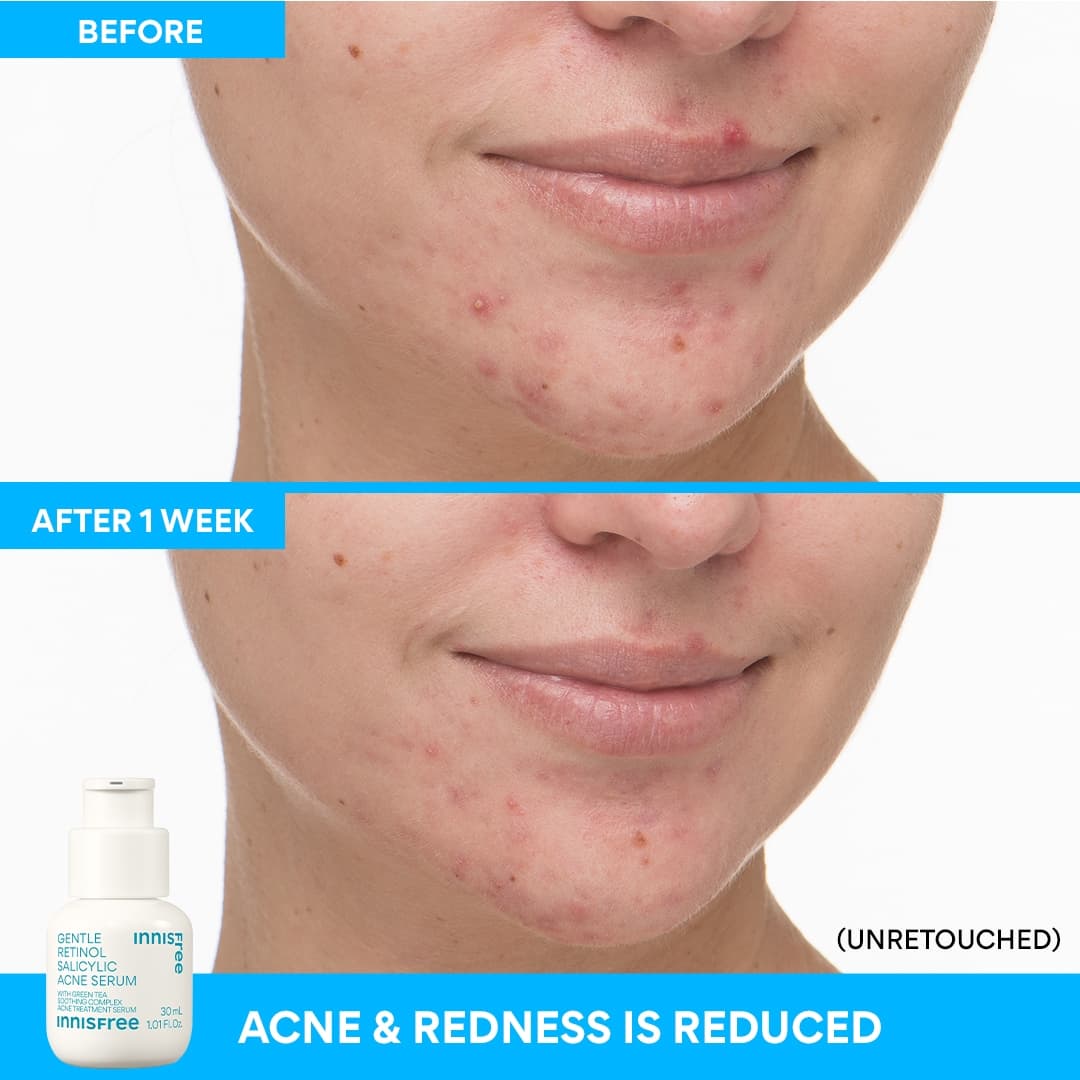 Gentle Retinol Salicylic Acne Serum - Image 5
