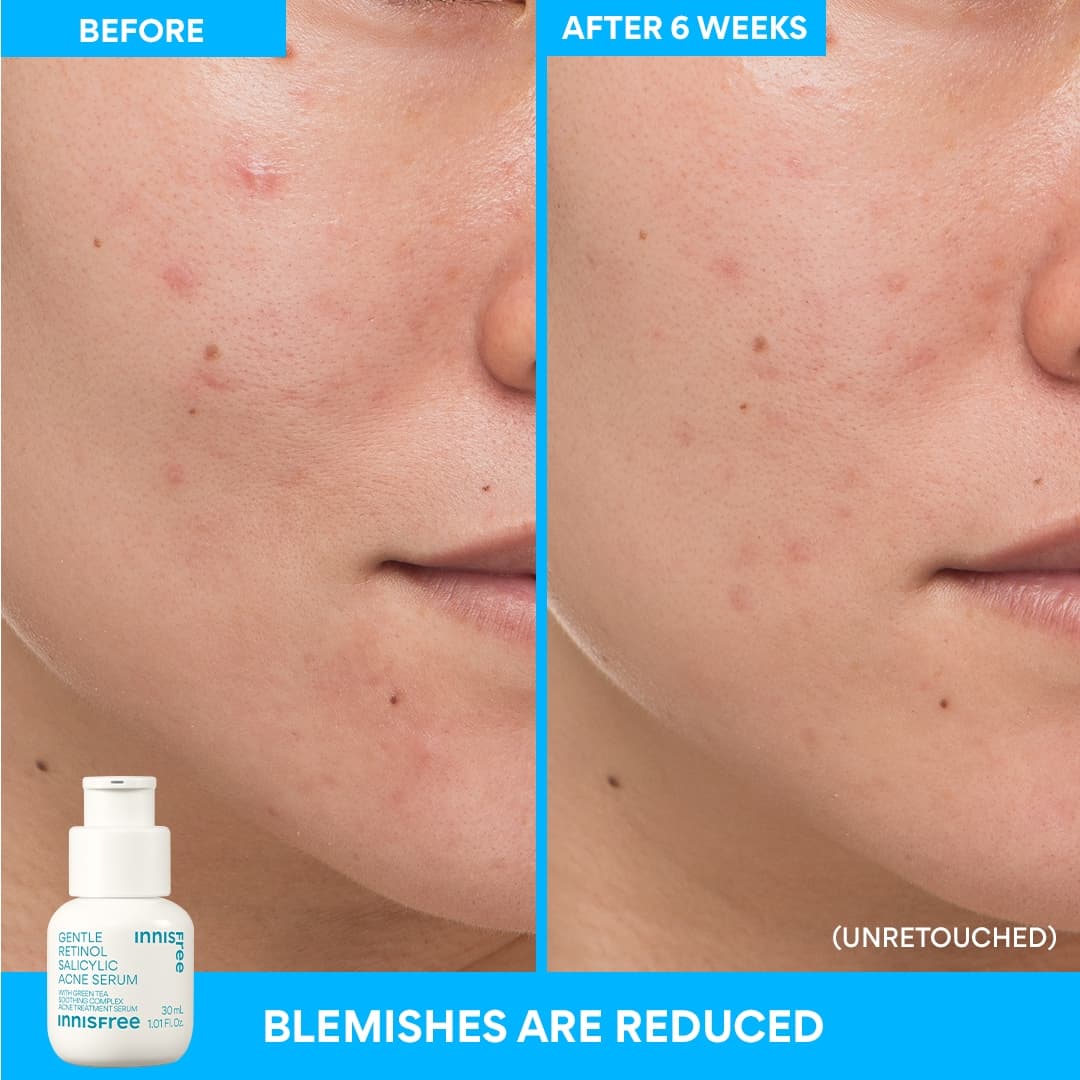 Gentle Retinol Salicylic Acne Serum - Image 10