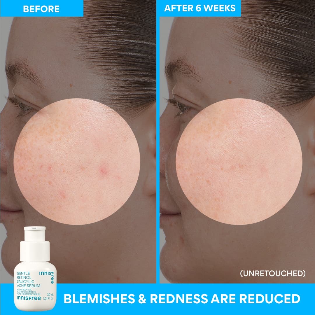 Gentle Retinol Salicylic Acne Serum - Image 12